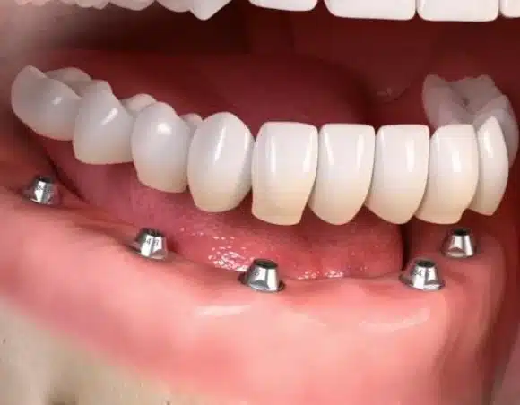 Implant supported fixed bridges