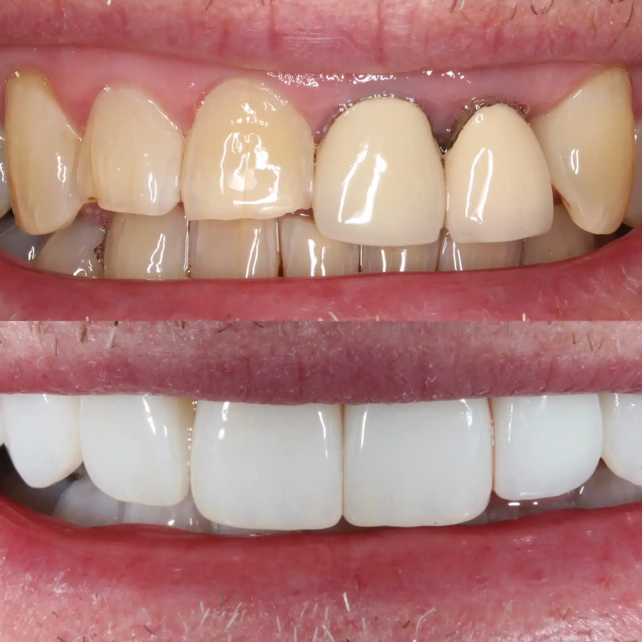 Porcelain Veneers Leicester 3