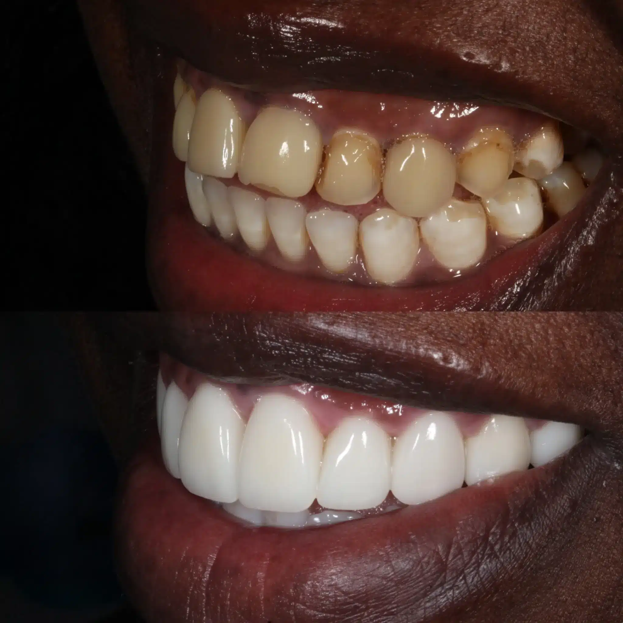 Porcelain Veneers Leicester