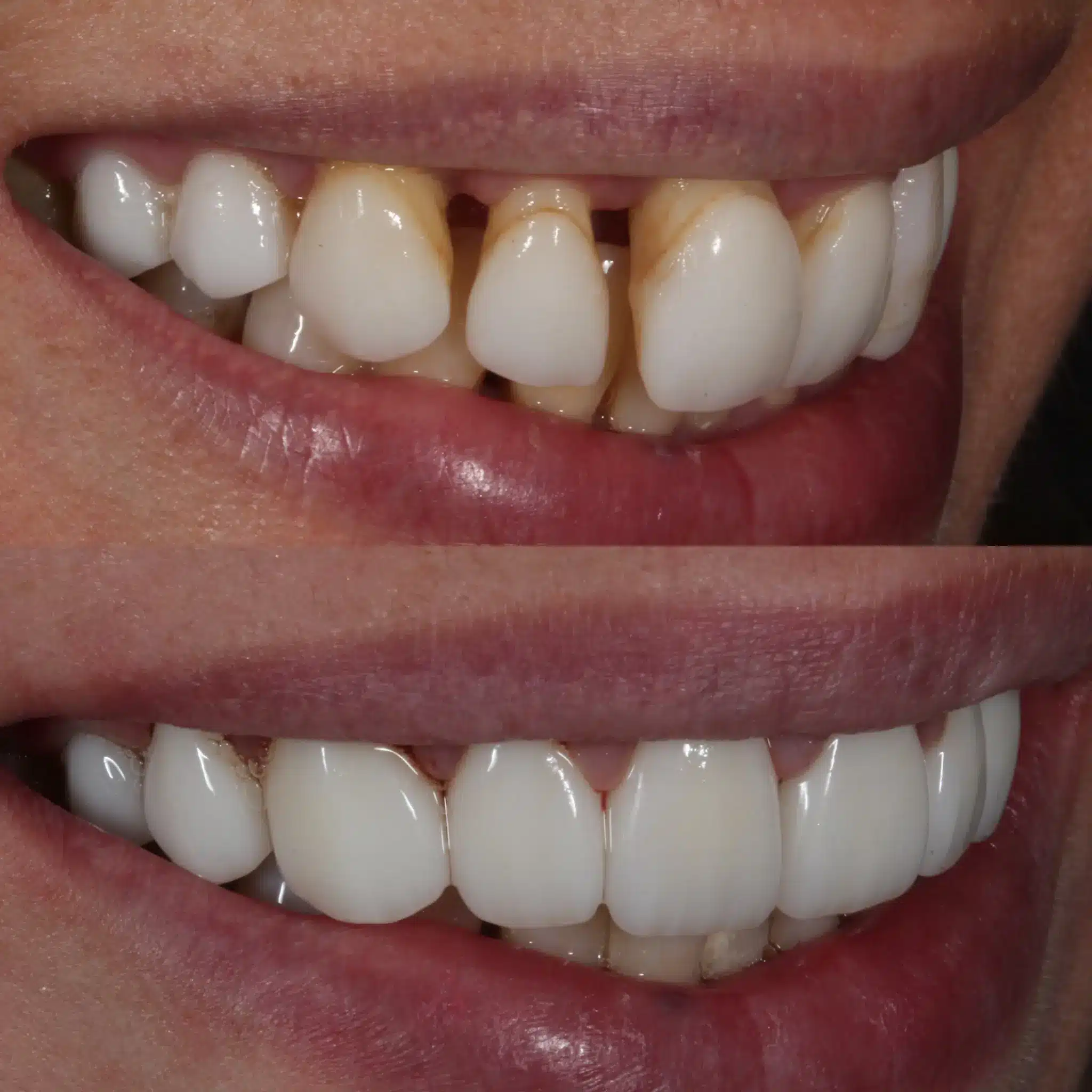 Porcelain Veneers Leicester 4