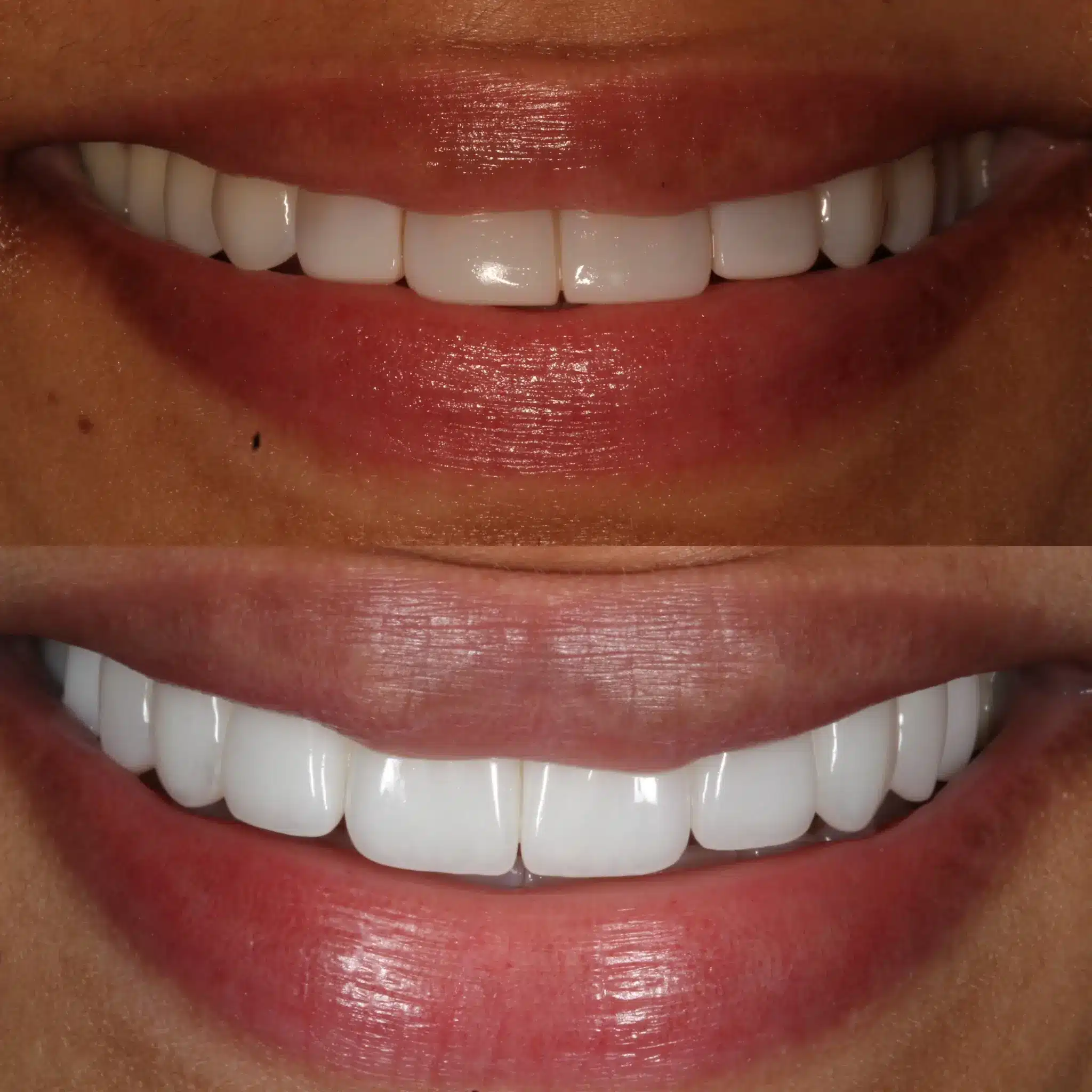 Porcelain Veneers Leicester 4