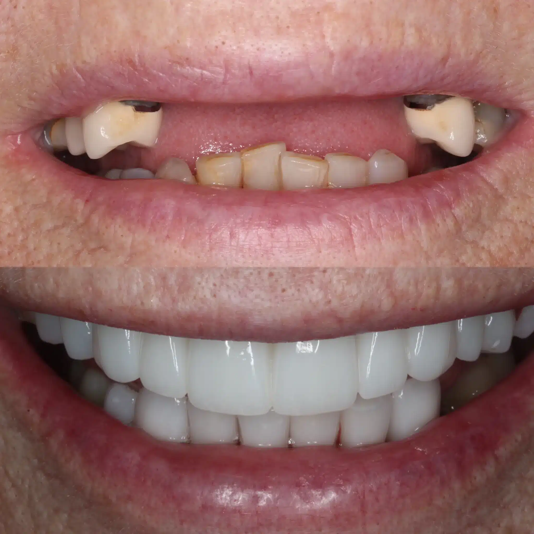 Porcelain Veneers Leicester 10