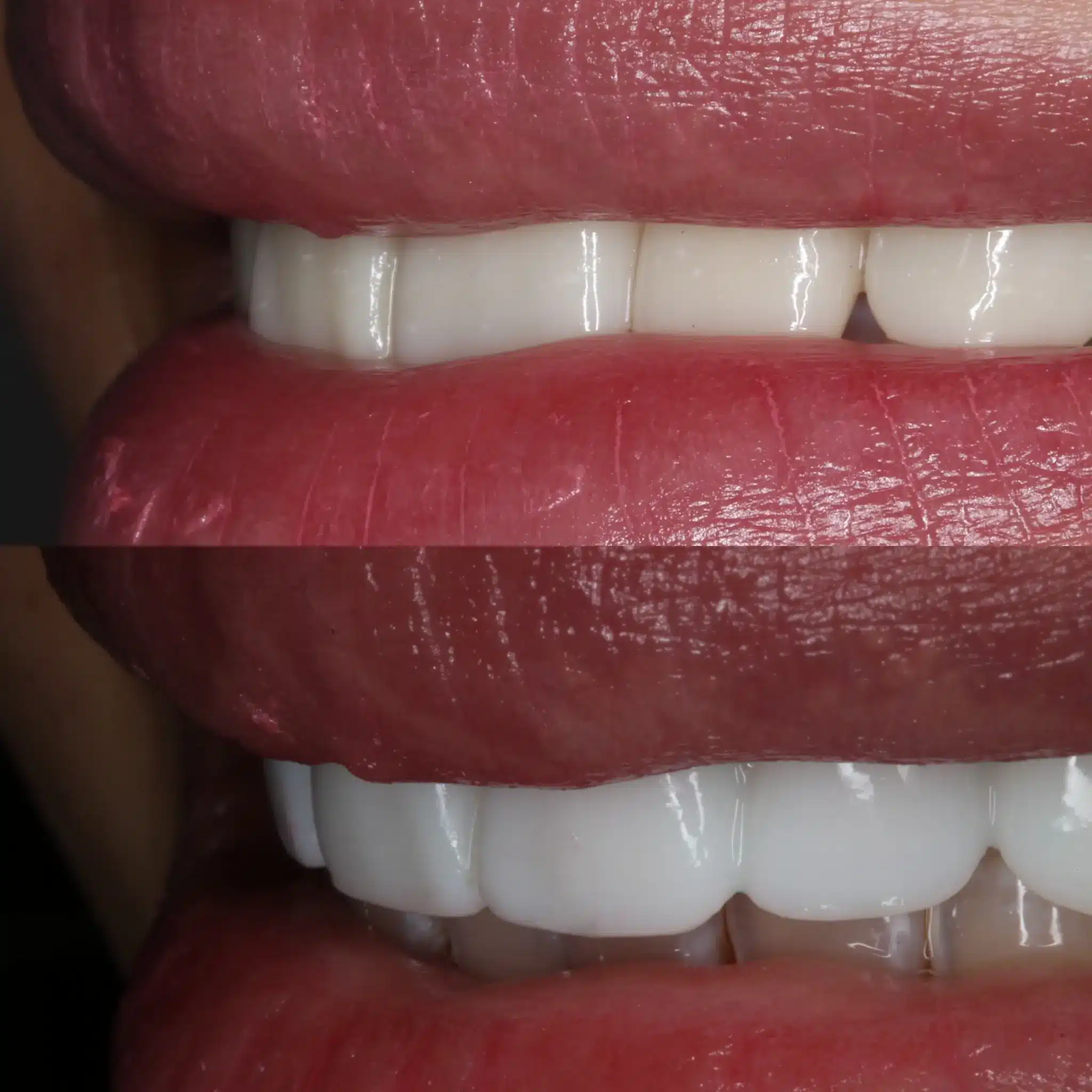 Porcelain Veneers Leicester 9