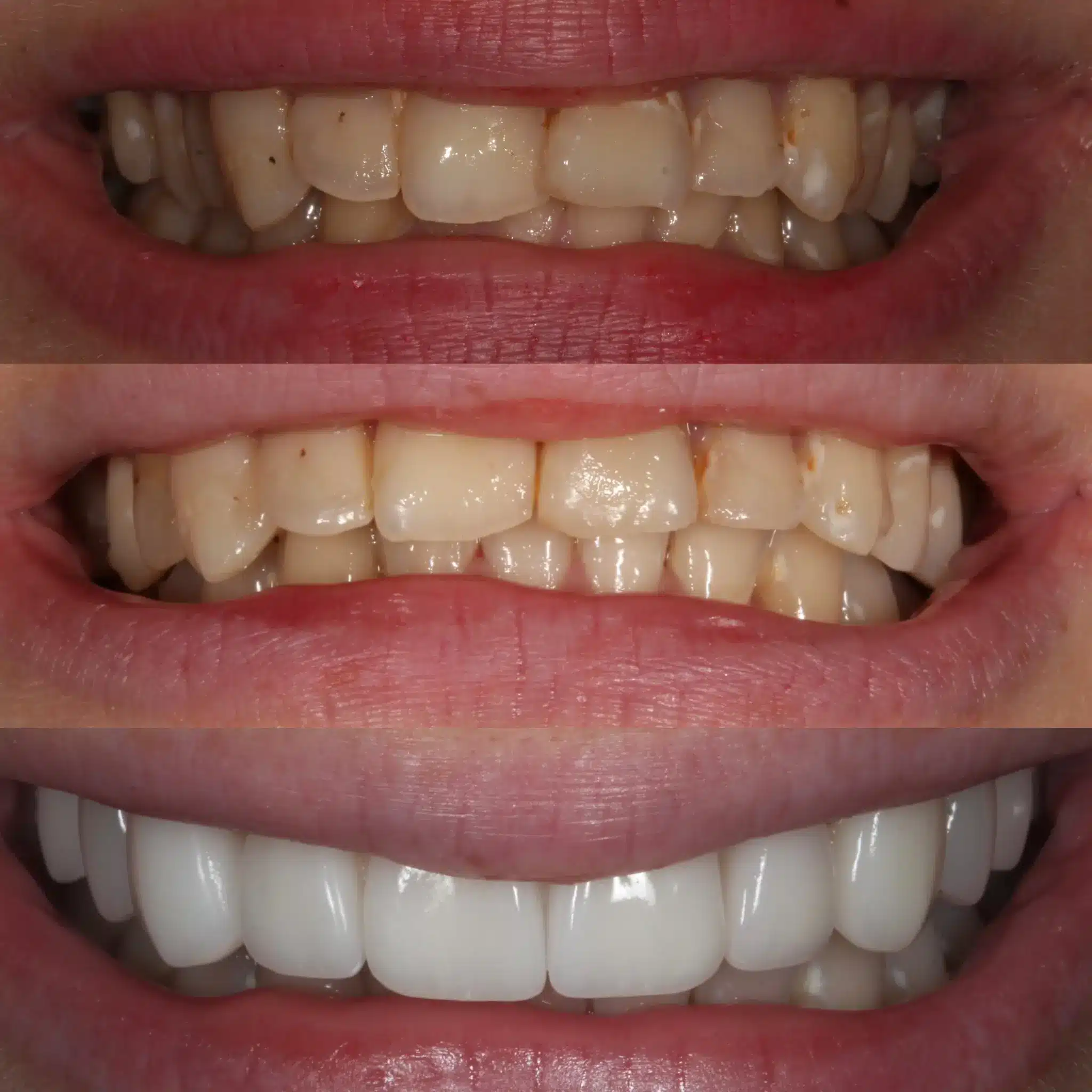 Porcelain Veneers Leicester 7
