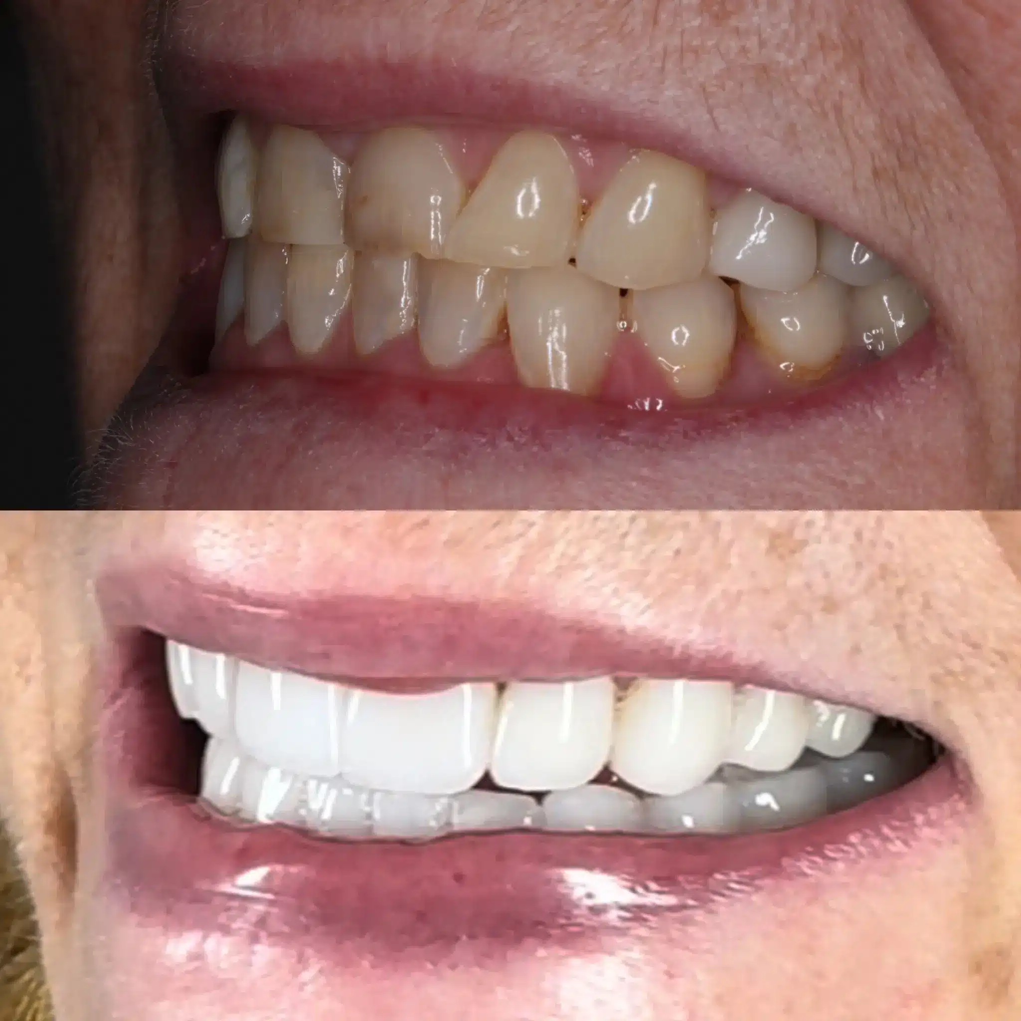 Porcelain Veneers Leicester 1