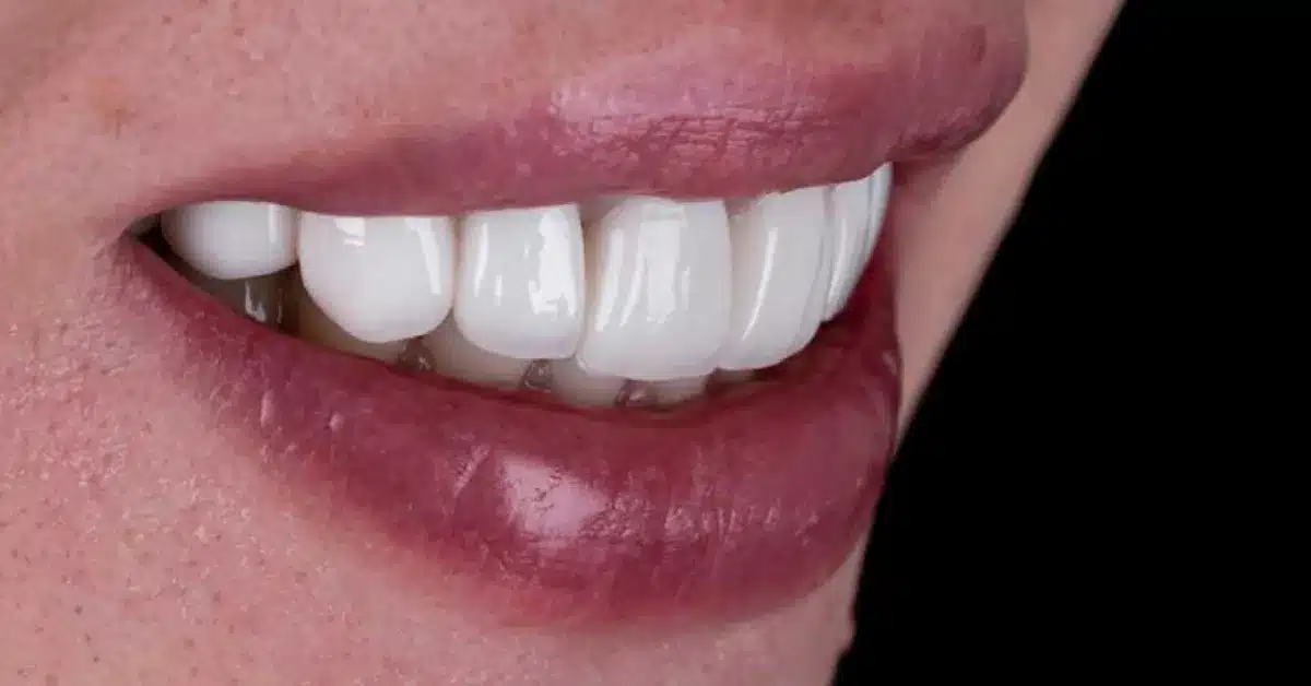 full mouth dental implants